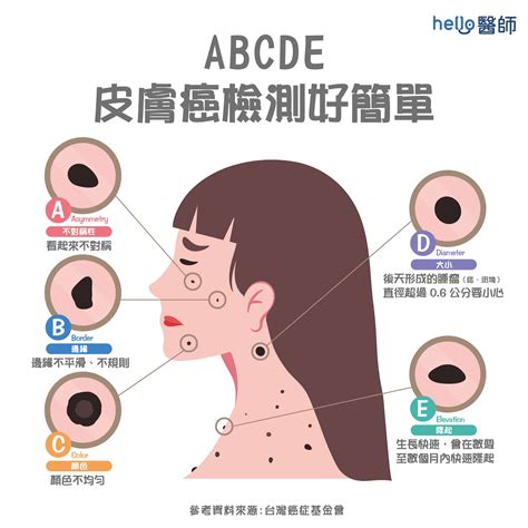 痣 斑|皮膚長痣、長斑是皮膚癌前兆？皮膚癌初期4大症狀快。